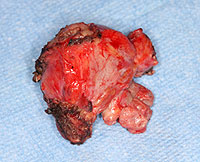 Removed prostate